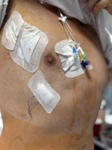 Вперше на Прикарпатті на базі ЦМКЛ провели протезування аортального клапану без розрізу грудної клітки