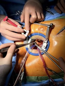 Вперше на Прикарпатті на базі ЦМКЛ провели протезування аортального клапану без розрізу грудної клітки